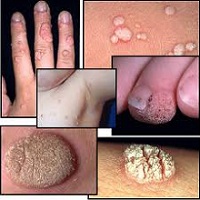 Common Types of Warts