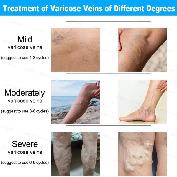 Varicose Veins Relieve Blue Light Laser Therapy Pen