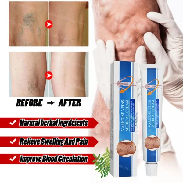 Varicose Veins Relieve Blue Light Laser Therapy Pen